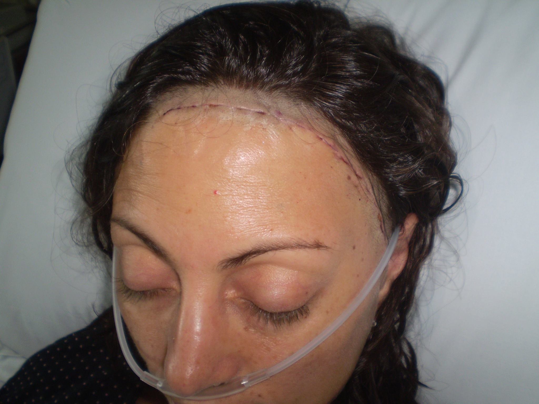 Recovering from cranial surgery, 2010.